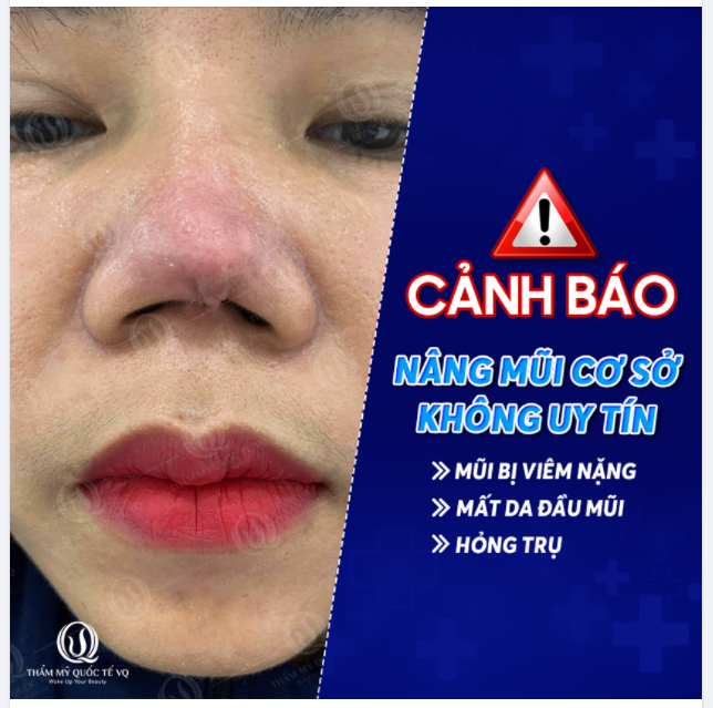 Nâng mũi hỏng đang xảy ra với rất nhiều khách hàng của các cơ sở không uy tín trong thời gian gần đây.