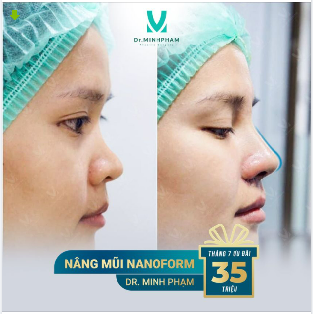 NÂNG MŨI NANOFORM CÓ ƯU ĐIỂM GÌ? Câu trả lời nằm trong FEEDBACK KH TRƯỚC VÀ SAU NÂNG MŨI