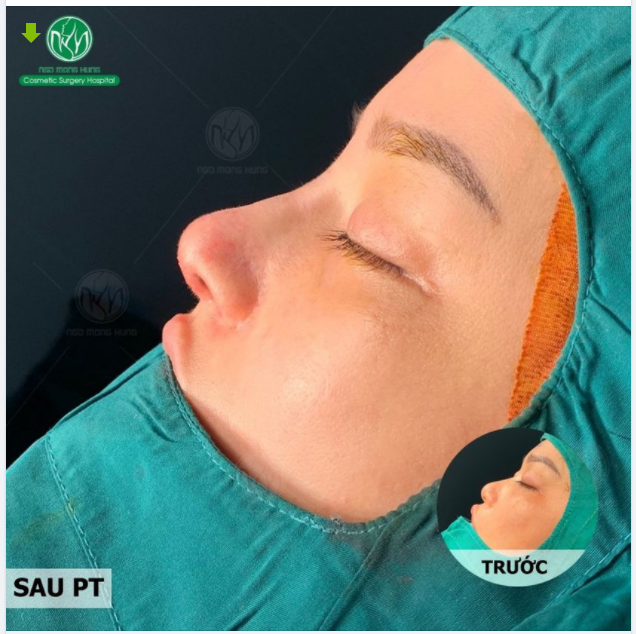 NÂNG MŨI S LINE - MŨI ĐẸP TOÀN DIỆN, DUY TRÌ BỀN LÂU