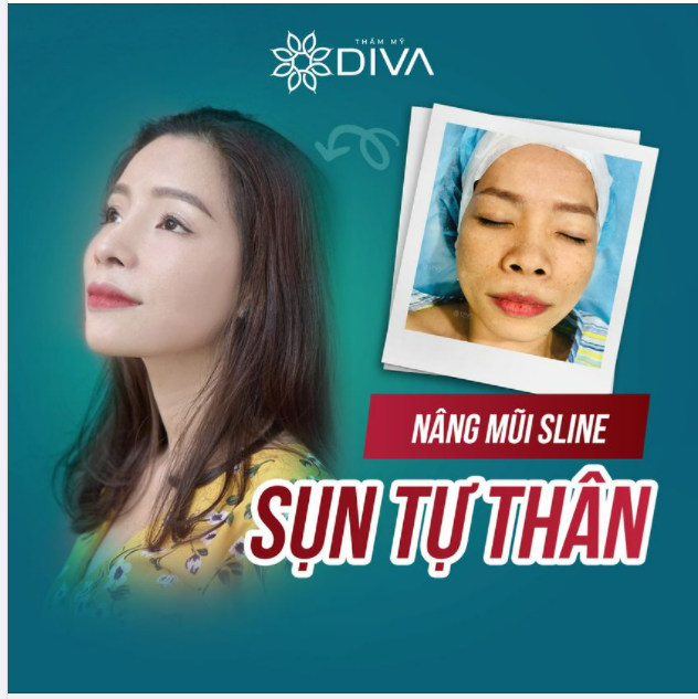 NÂNG MŨI SLINE SỤN TỰ THÂN: NÂNG TẦM NHAN SẮC
