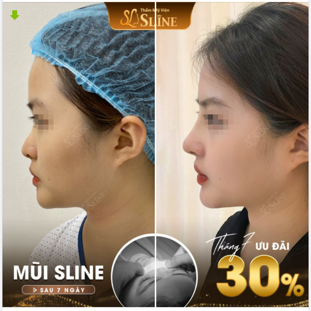 NÂNG  MŨI SLINE
