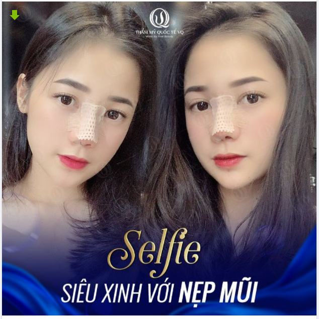 Nâng mũi Softline - Đẹp từ nẹp mũi đẹp đi