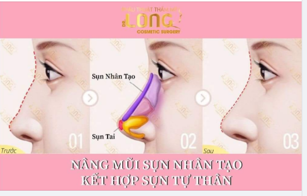 Nâng mũi sụn nhân tạo kết hợp sụn tự thân mang lại ưu điểm gì