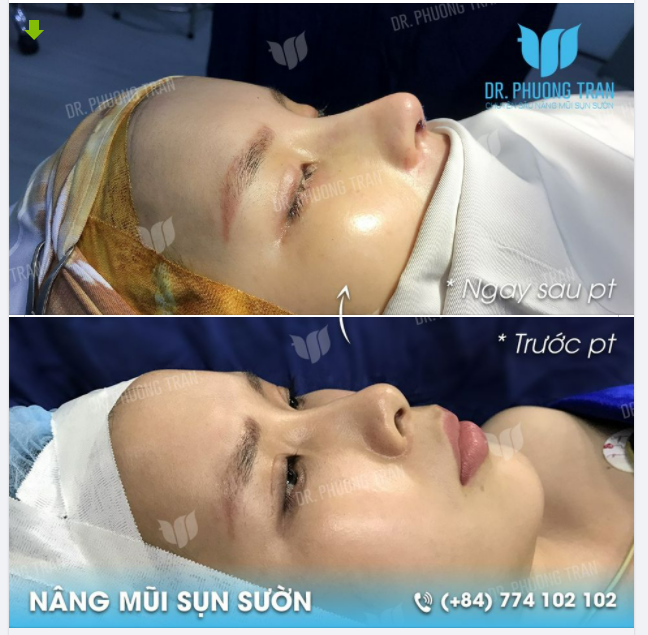 NÂNG MŨI SỤN SƯỜN TỰ THÂN