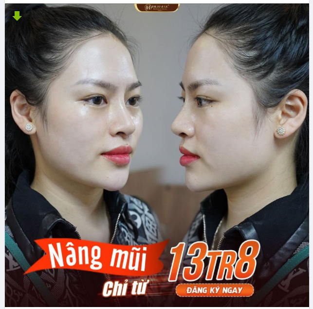 Nâng mũi thẩm mỹ tại Dr.Hải Lê Mũi cao sang, đẹp mọi góc nhìn