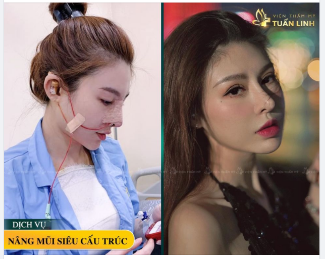 NÂNG MŨI TRẢ GÓP - GIÁ SALE KHỦNG CHỈ TỪ 7TRIỆU