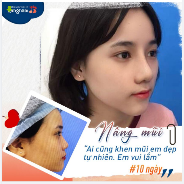 Nâng mũi tự nhiên Trẻ ra vài tuổi cả nhà ơi