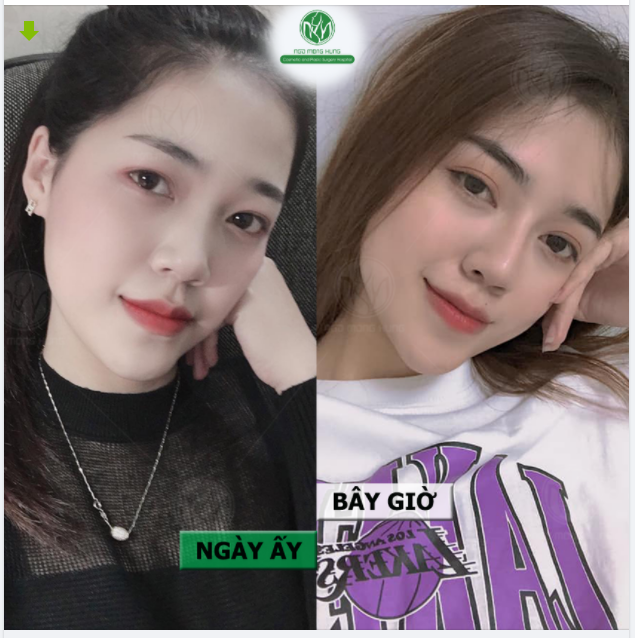 NÂNG MŨI XONG SẼ THAY ĐỔI NHƯ THẾ NÀO??