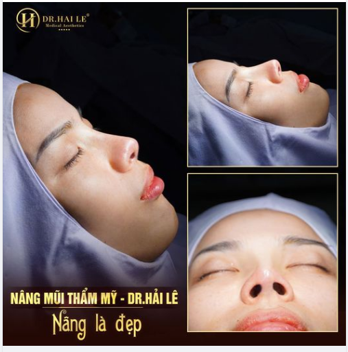 Nâng mũi xong thấy mình xinh hơn hẳn, nhìn không nhận ra.....