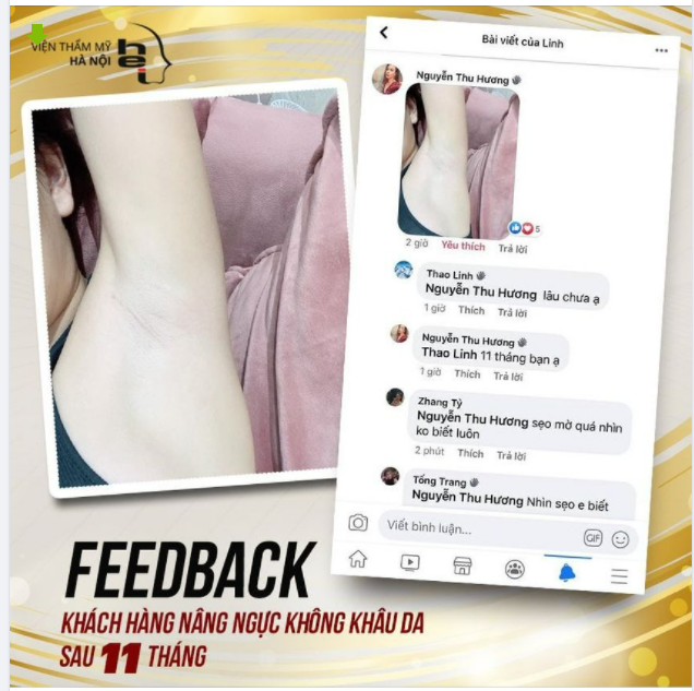 NÂNG NGỰC KHÔNG LO SẸO VỚI PHƯƠNG PHÁP PHẪU THUẬT KHÔNG KHÂU DA