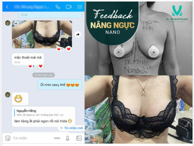 NÂNG NGỰC NANO – HÔ BIẾN “MƯỚP” THÀNH “BƯỞI” ƯU ĐÃI CỰC SỐC CHỈ TỪ 45,9TR – BẢO HÀNH TRỌN ĐỜI