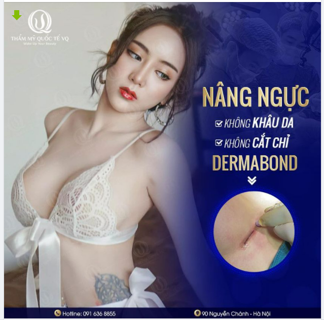 Nâng ngực KHÔNG KHÂU DA, KHÔNG CẦN CẮT CHỈ