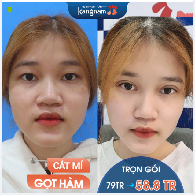 NÀNG ƠI, TRANH THỦ MÙA DỊCH ĐƯỢC NGHỈ ĐI THẨM MỸ THÔI
