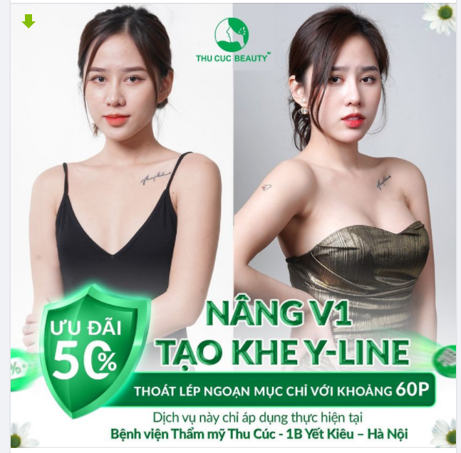 NÂNG V1 TẠO KHE Y-LINE - GIÁ CỰC ƯU ĐÃI CHỈ TỪ 38.2 TRIỆU