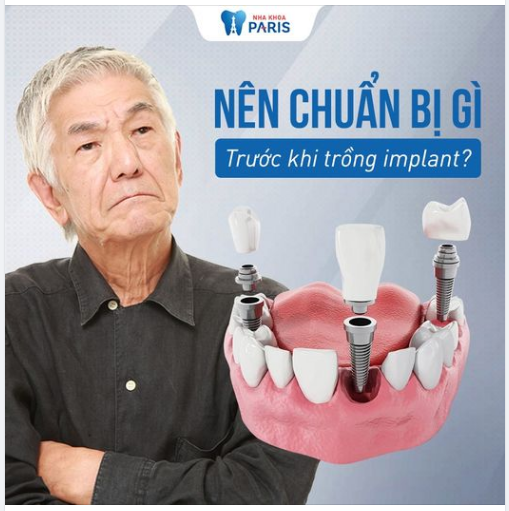 Nên Chuẩn Bị Gì Trước Khi Trồng Răng Implant