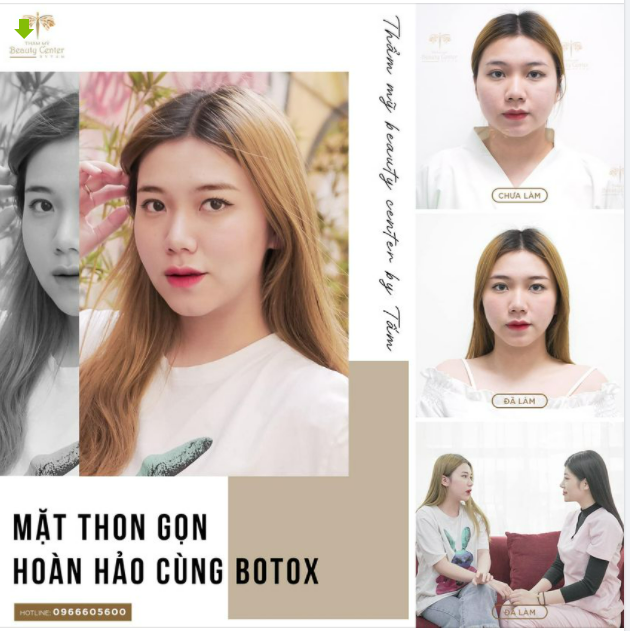 Nếu bạn không tin vào sức mạnh kì diệu của Botox Pháp tại Tấm thì hãy bỏ ra 30 giây xem hình ảnh chân thực về hiệu quả trước và sau khi làm Botox thon gọn hàm này.