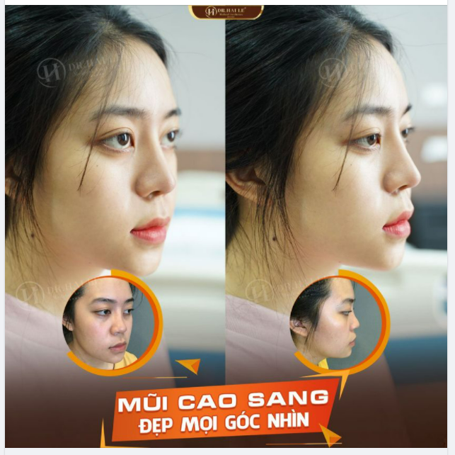 Nghe đồn Dr.Hải Lê nâng mũi đẹp nhẹ nhàng mà nhìn tự nhiên hết nấc Không phải đồn đâu, chính xác là như vậy đó.