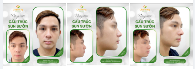 Nghe nói mũi cấu trúc chỉ chuyên chỉnh những chiếc mũi nhiều khuyết điểm, dáng mũi xấu, vậy có trường hợp nào mũi đã có dáng, độ cao tương đối mà vẫn cần đến phương pháp mũi cấu trúc không?
