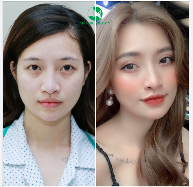 Ngỡ ngàng trước sự khác biệt to lớn sau khoảng 5 ngày Cắt Mí Sạch Khuẩn
