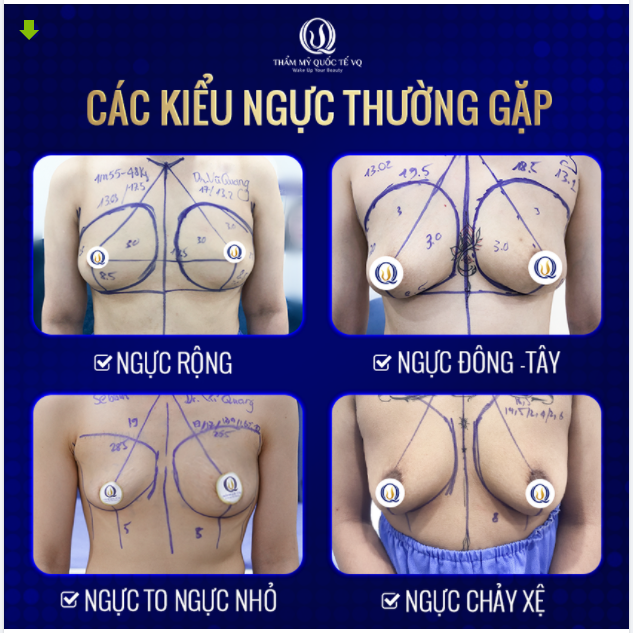 Ngực bạn thuộc dạng nào