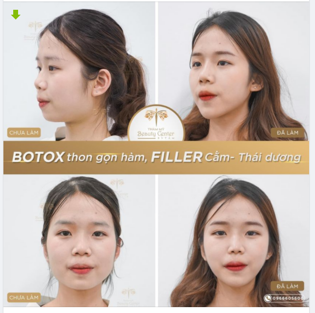 Người thật- Hình thật: Hiệu quả của Botox thon gọn hàm và Filler cằm tại Tấm