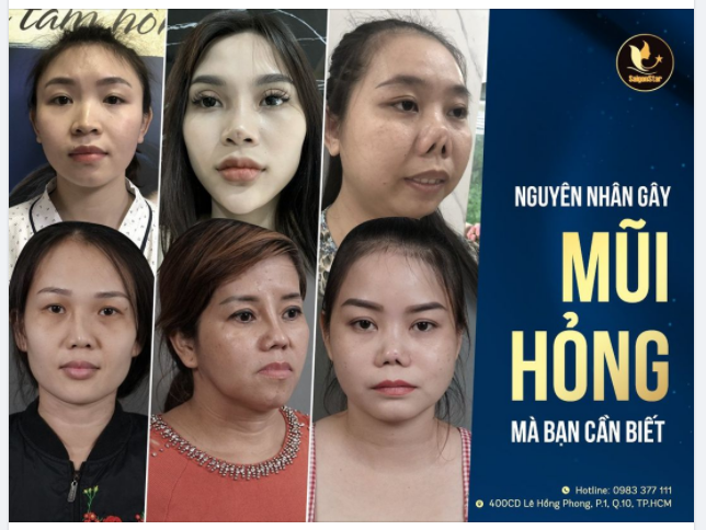 NGUYÊN NHÂN GÂY MŨI HỎNG MÀ BẠN CẦN BIẾT