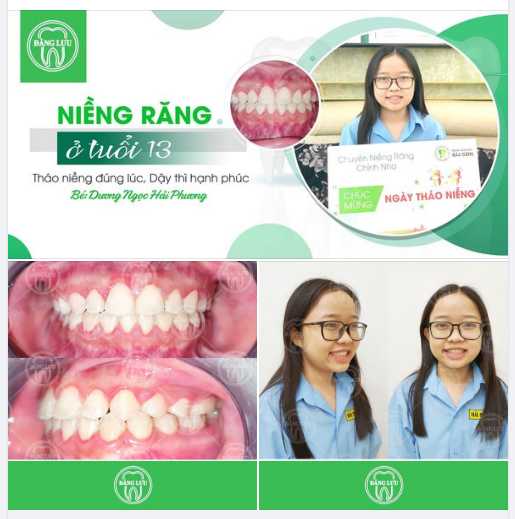 Nha Khoa Đăng Lưu chúc mừng bé Dương Ngọc Hải Phương đã Niềng răng thành công sau hơn 1 năm! Điều trị thành công tình trạng cắn ngược, thưa răng.