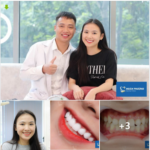 Nha khoa Ngân Phượng tự hào đồng hành cùng chị chia tay răng thưa, ố; tìm lại nụ cười rạng rỡ, tự tin và hạnh phúc.