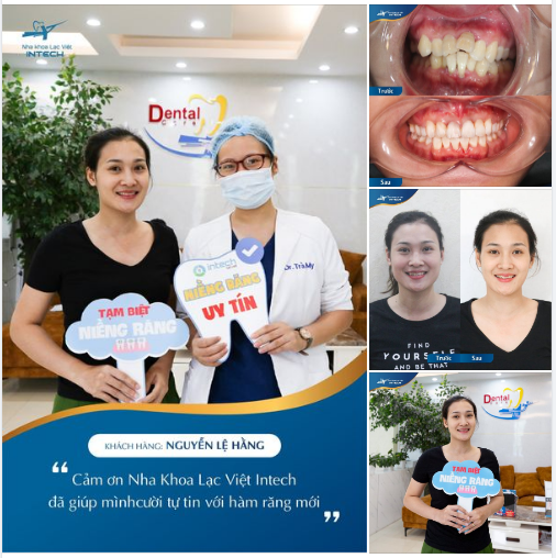 NHÂN ĐÔI NIỀM VUI TRONG NGÀY THÁO MẮC CÀI: ĐÓN HÀM RĂNG ĐẸP CÙNG NỤ CƯỜI TỰ TIN
