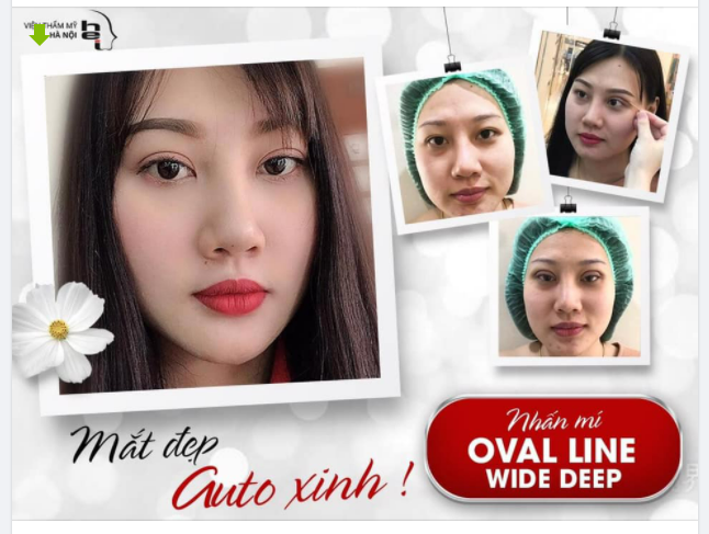 NHẤN MÍ - MẮT ĐẸP - AUTO XINH