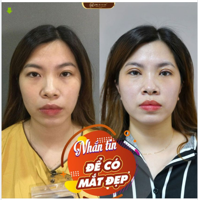 NHẮN TIN ngay để có mí đẹp CẮT MÍ thẩm mỹ Dr.Hải Lê HƯỞNG TRỌN ĐÔI MẮT 2 MÍ RẠNG NGỜI TƯƠI TRẺ với chi phí siêu ưu đãi, chỉ từ 6tr8