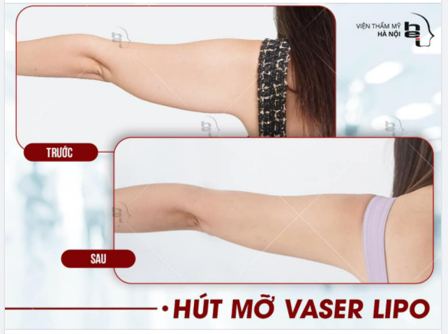 Nhiều mỡ bắp tay không dễ dàng loại bỏ, tốn nhiều thời gian tập luyện mà chưa chắc có hiệu quả.