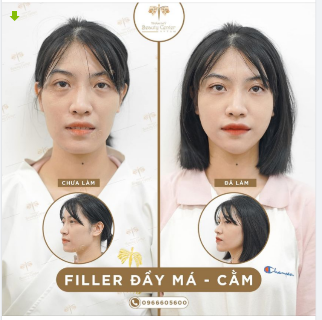 Nhiều người đau đầu vì má phính, mặt to