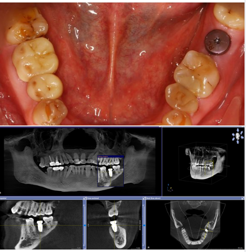 Nhiều người nghĩ đặt Implant sẽ đau và chảy máu nhiều...
