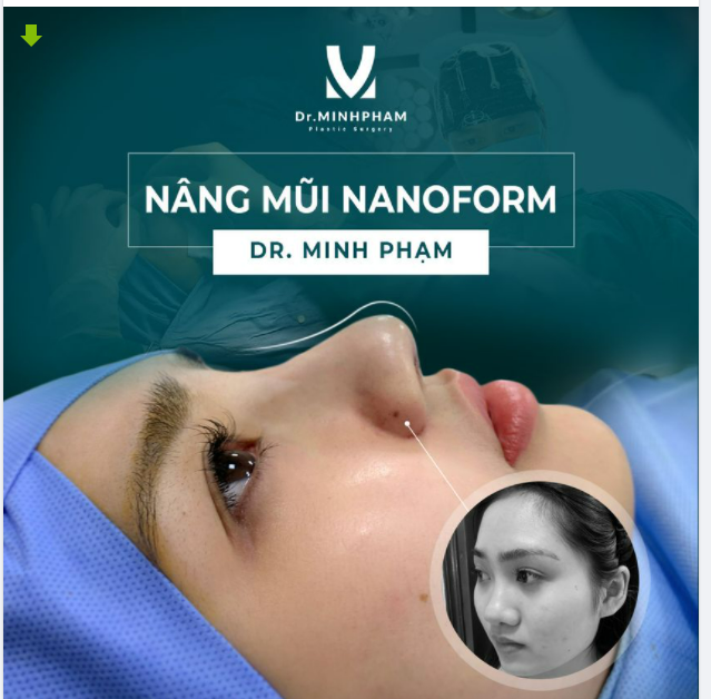 NHÌN LÀ ĐẮM – NGẮM LÀ YÊU MŨI NANO FORM ĐẸP CHUẨN TỪNG LI