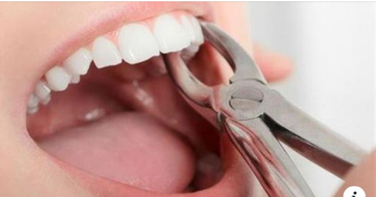 NHỔ RĂNG CỬA ĐƯỢC CHỈ ĐỊNH CHO NHỮNG TRƯỜNG HỢP NÀO?