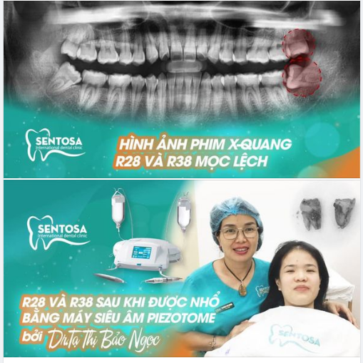 NHỔ RĂNG KHÔN CÓ ĐAU KHÔNG?