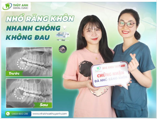 NHỔ RĂNG KHÔN NHẸ NHÀNG HƠN VỚI MÁY RUNG SIÊU ÂM PIEZOTOME