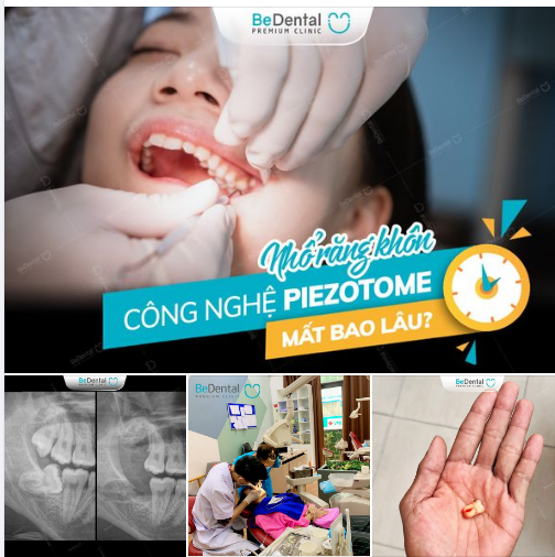 NHỔ RĂNG VỚI CÔNG NGHỆ PIEZOTOME MẤT BAO LÂU?