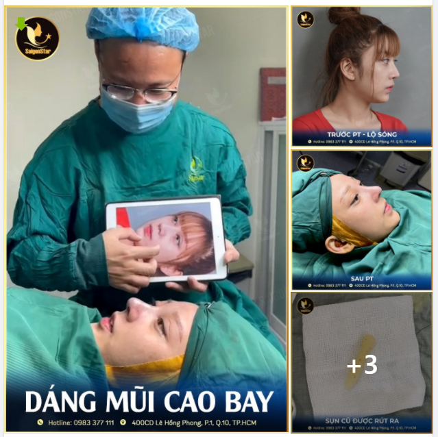 Những biến chứng có thể gặp khi bị LỘ SÓNG sau nâng mũi