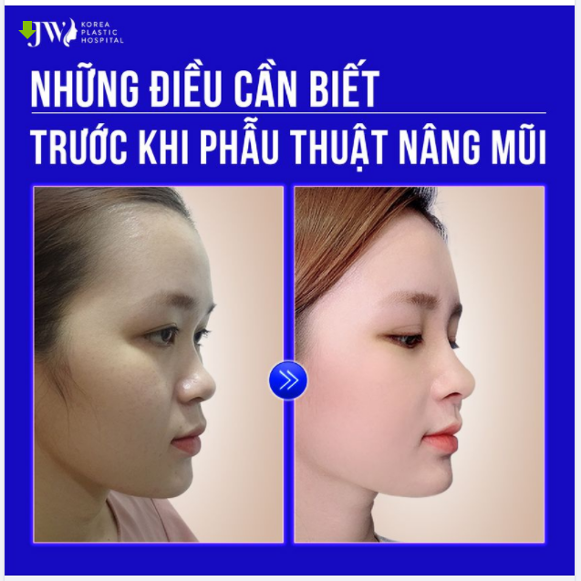 NHỮNG ĐIỀU BẠN CẦN BIẾT TRƯỚC KHI QUYẾT ĐỊNH PHẪU THUẬT THẨM MỸ NÂNG MŨI S LINE