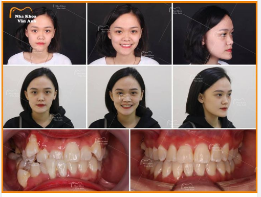 NHỮNG ĐIỀU CẦN BIẾT TRƯỚC KHI  NIỀNG RĂNG