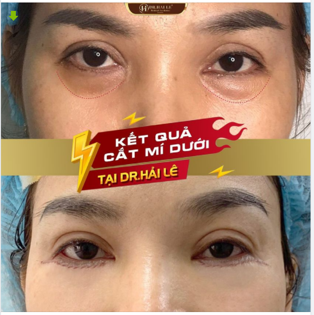 NHỮNG ĐIỀU CẦN BIẾT TRƯỚC KHI THỰC HIỆN CẮT MÍ DƯỚI.!!