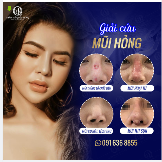 NHỮNG LỢI ÍCH CÓ 1 KHÔNG 2 KHI SỬA MŨI HỎNG TẠI VQ