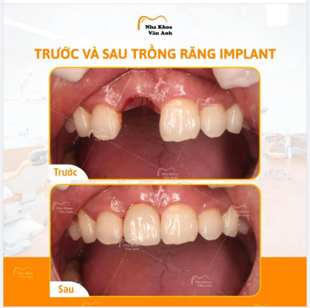 NHỮNG TRƯỜNG HỢP NÀO CÓ THỂ TRỒNG RĂNG IMPLANT CÔNG NGHỆ 4D GUIDE ???