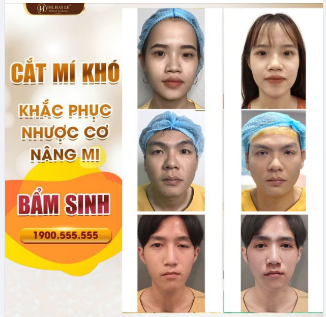 Nhược cơ nâng mi bẩm sinh chính là tình trạng khó mà rất nhiều khách hàng gặp phải và không phải cơ sở nào cũng xử lý được.!