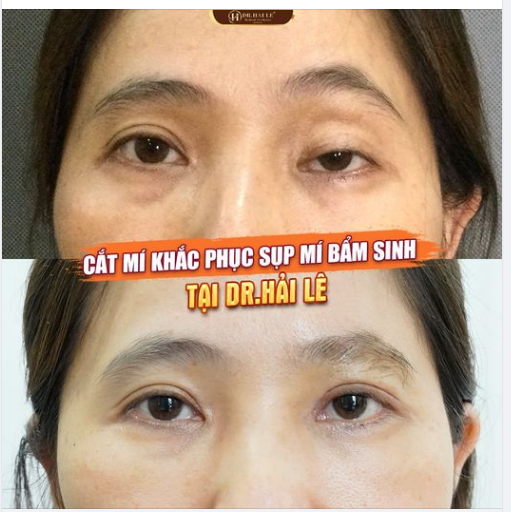 Nhược cơ nâng mi gây sụp mí bẩm sinh có khắc phục được không?