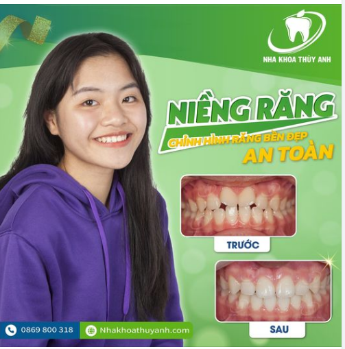 NIỀNG 1 LẦN ĐẸP TRỌN ĐỜI VỚI NHA KHOA THÙY ANH