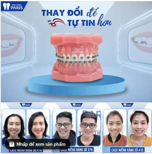 NIỀNG 6 THÁNG HẾT KHẤP KHỂNH