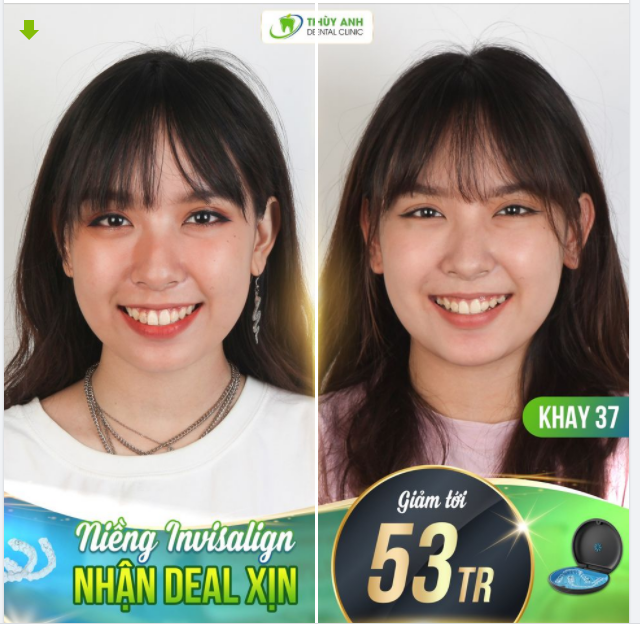 NIỀNG INVISALIGN CHUẨN MỸ NHẬN DEAL XỊN